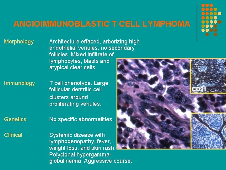 ANGIOIMMUNOBLASTIC T CELL LYMPHOMA Morphology Architecture effaced, arborizing high endothelial venules, no secondary follicles.