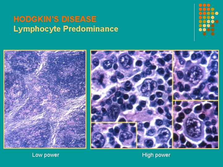 HODGKIN’S DISEASE Lymphocyte Predominance Low power High power 