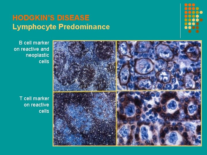 HODGKIN’S DISEASE Lymphocyte Predominance B cell marker on reactive and neoplastic cells T cell