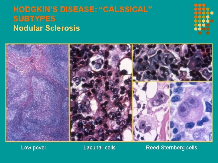 HODGKIN’S DISEASE: “CALSSICAL” SUBTYPES Nodular Sclerosis Low pover Lacunar cells Reed-Sternberg cells 