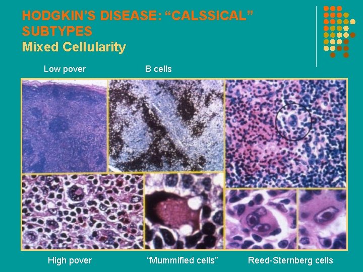 HODGKIN’S DISEASE: “CALSSICAL” SUBTYPES Mixed Cellularity Low pover High pover B cells “Mummified cells”