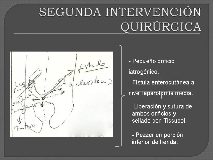- Pequeño orificio iatrogénico. - Fístula enterocutánea a nivel laparotomía media. -Liberación y sutura - Pequeño orificio iatrogénico. - Fístula enterocutánea a nivel laparotomía media. -Liberación y sutura