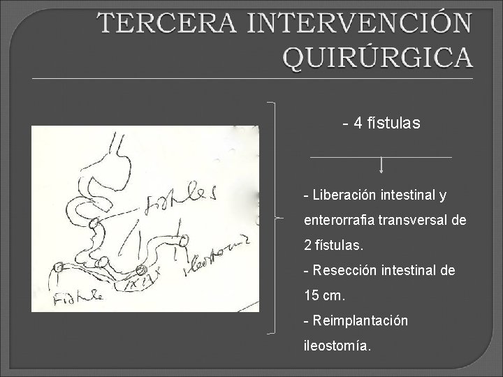 - 4 fístulas - Liberación intestinal y enterorrafia transversal de 2 fístulas. - Resección - 4 fístulas - Liberación intestinal y enterorrafia transversal de 2 fístulas. - Resección