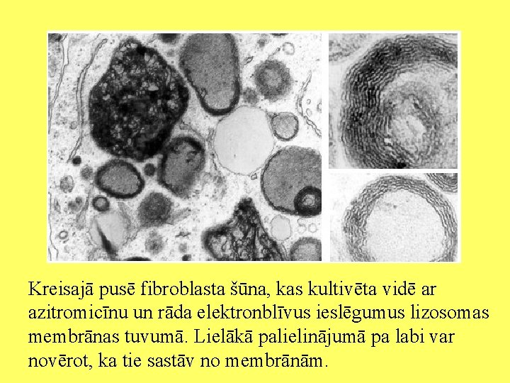 Kreisajā pusē fibroblasta šūna, kas kultivēta vidē ar azitromicīnu un rāda elektronblīvus ieslēgumus lizosomas
