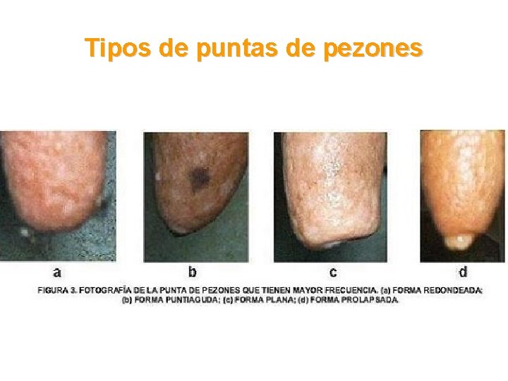 Tipos de puntas de pezones 