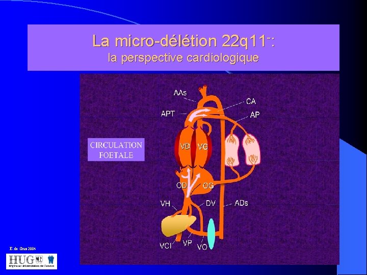 La micro-délétion 22 q 11 -: la perspective cardiologique E. da Cruz 2004 