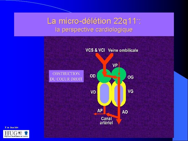 La micro-délétion 22 q 11 -: la perspective cardiologique E. da Cruz 2004 
