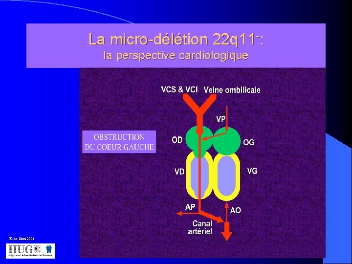 La micro-délétion 22 q 11 -: la perspective cardiologique E. da Cruz 2004 