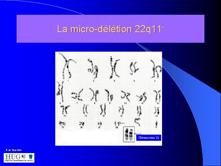 La micro-délétion 22 q 11 - Chromosome 22 E. da Cruz 2004 