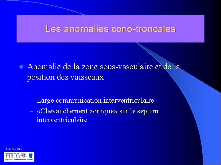 Les anomalies cono-troncales l Anomalie de la zone sous-vasculaire et de la position des