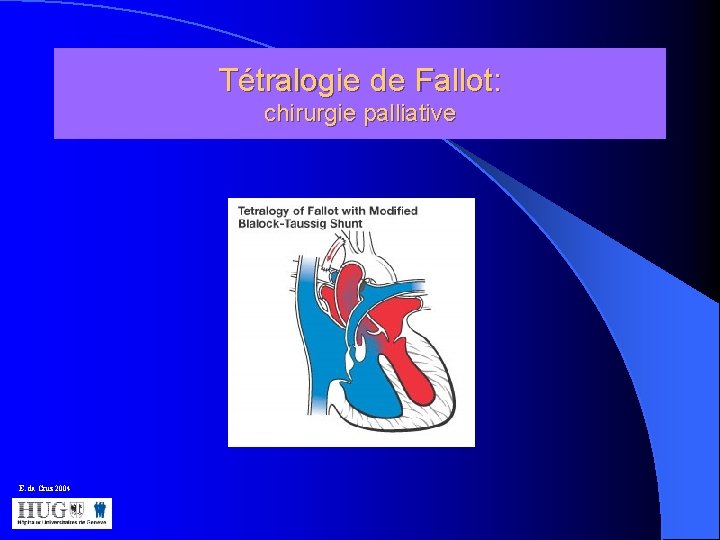 Tétralogie de Fallot: chirurgie palliative E. da Cruz 2004 
