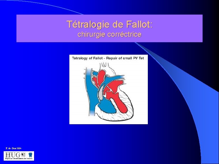 Tétralogie de Fallot: chirurgie corréctrice E. da Cruz 2004 