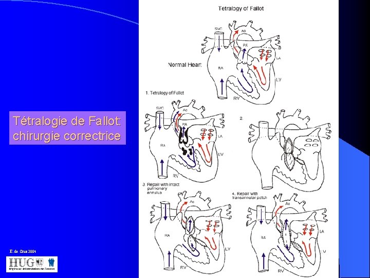  Tétralogie de Fallot: chirurgie correctrice E. da Cruz 2004 