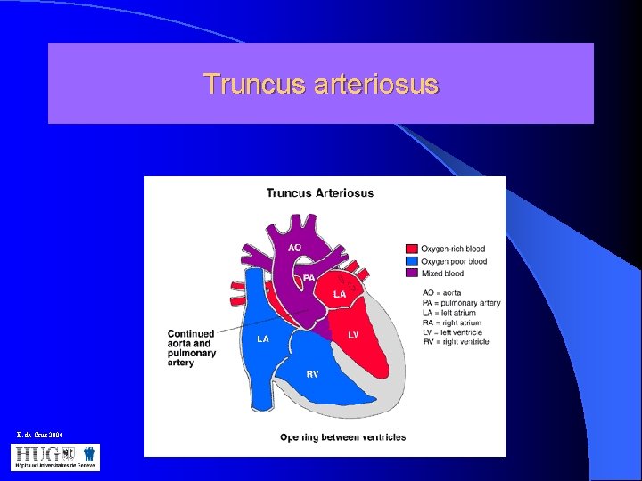 Truncus arteriosus E. da Cruz 2004 