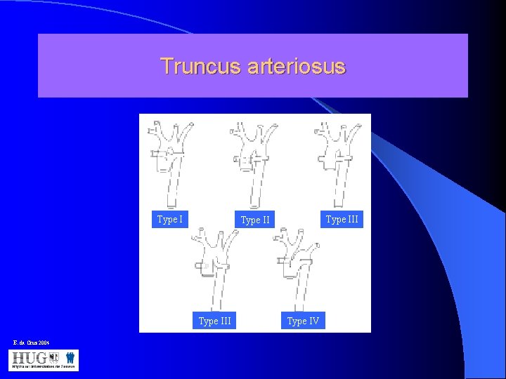 Truncus arteriosus Type III Type 1 Type III E. da Cruz 2004 Type IV