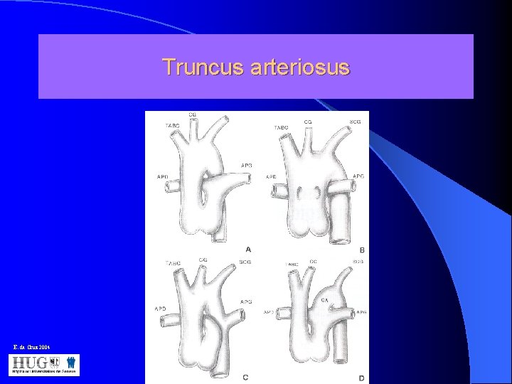 Truncus arteriosus E. da Cruz 2004 