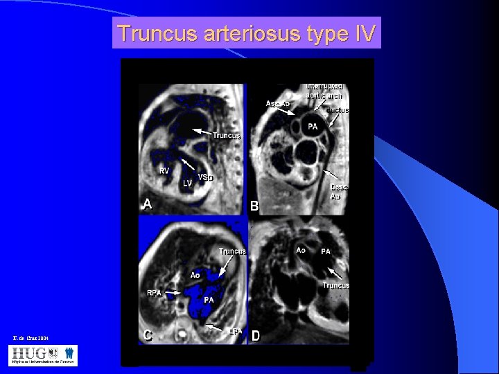 Truncus arteriosus type IV E. da Cruz 2004 