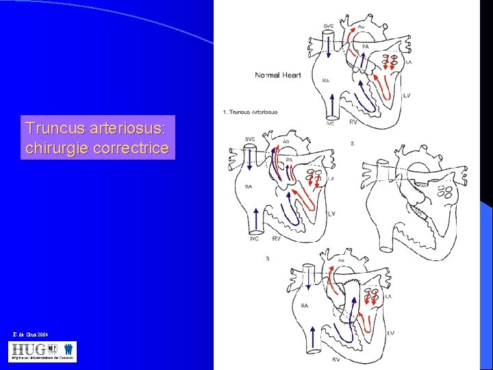  Truncus arteriosus: chirurgie correctrice E. da Cruz 2004 