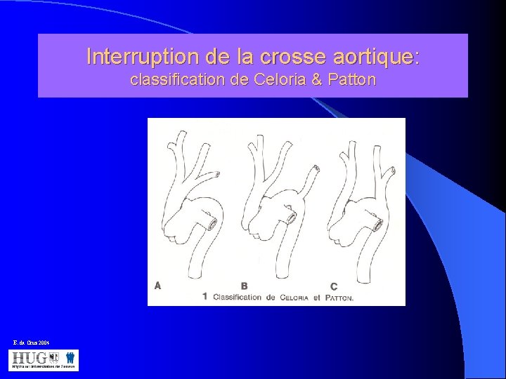 Interruption de la crosse aortique: classification de Celoria & Patton E. da Cruz 2004