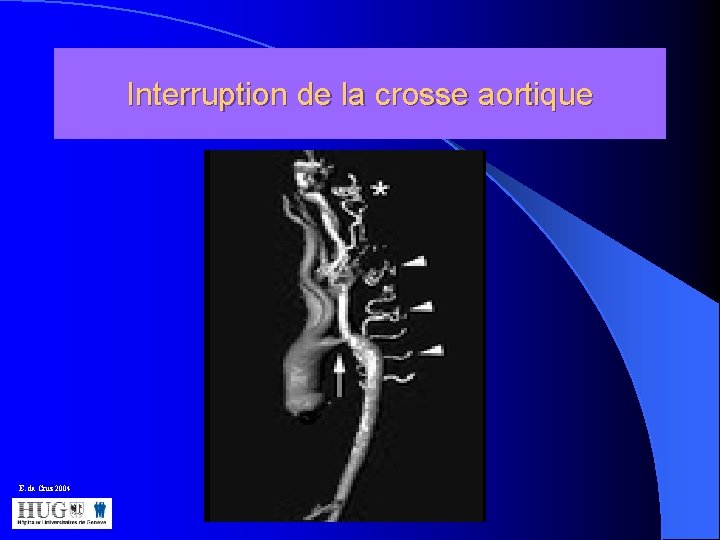 Interruption de la crosse aortique E. da Cruz 2004 