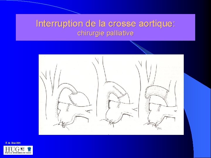 Interruption de la crosse aortique: chirurgie palliative E. da Cruz 2004 