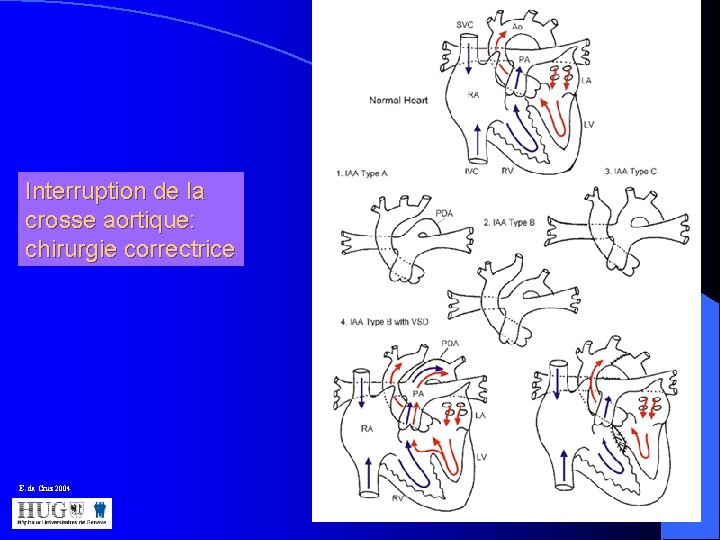  Interruption de la crosse aortique: chirurgie correctrice E. da Cruz 2004 