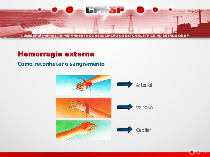 Hemorragia externa Como reconhecer o sangramento Arterial Venoso Capilar 