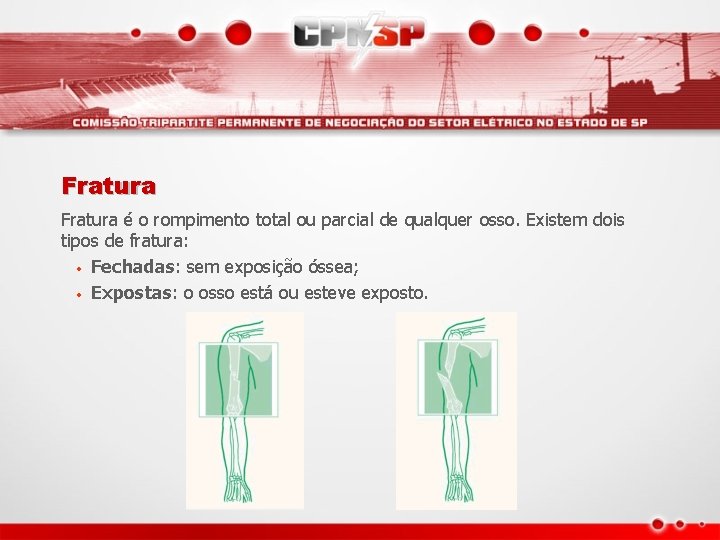 Fratura é o rompimento total ou parcial de qualquer osso. Existem dois tipos de