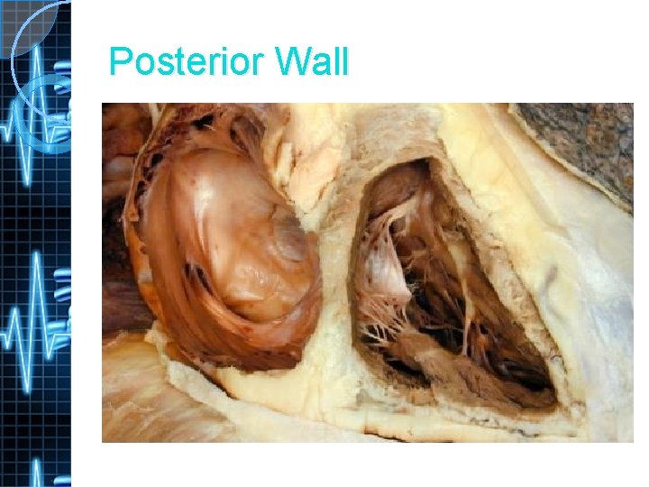 Posterior Wall 