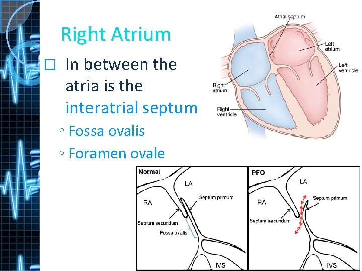 Right Atrium � In between the atria is the interatrial septum ◦ Fossa ovalis