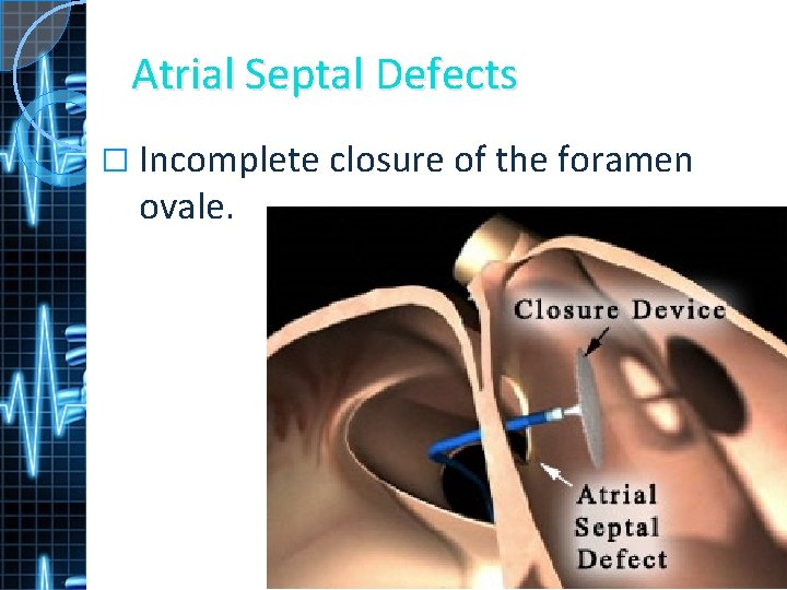 Atrial Septal Defects � Incomplete closure of the foramen ovale. 