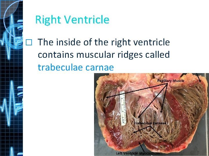 Right Ventricle � The inside of the right ventricle contains muscular ridges called trabeculae