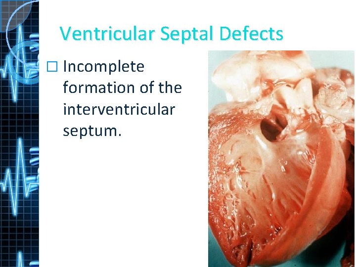 Ventricular Septal Defects � Incomplete formation of the interventricular septum. 