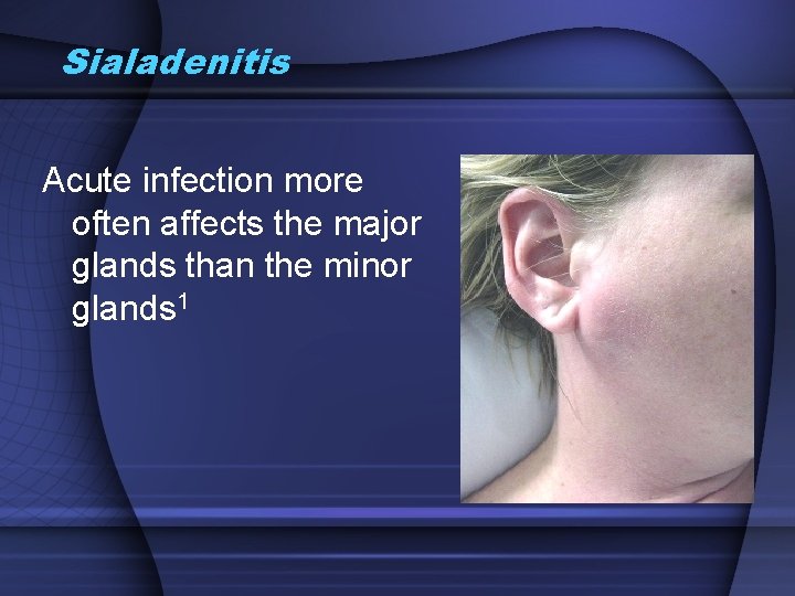 Sialadenitis Acute infection more often affects the major glands than the minor glands 1