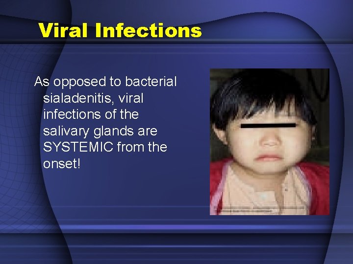 Viral Infections As opposed to bacterial sialadenitis, viral infections of the salivary glands are