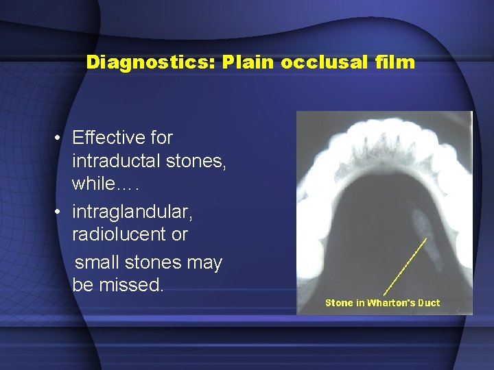 Diagnostics: Plain occlusal film • Effective for intraductal stones, while…. • intraglandular, radiolucent or