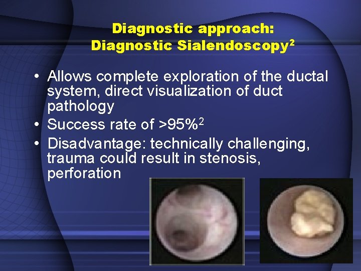 Diagnostic approach: Diagnostic Sialendoscopy 2 • Allows complete exploration of the ductal system, direct