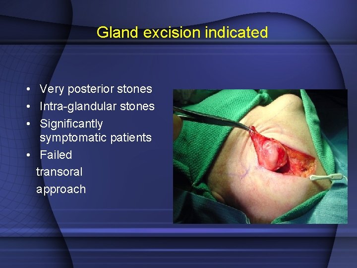 Gland excision indicated • Very posterior stones • Intra-glandular stones • Significantly symptomatic patients