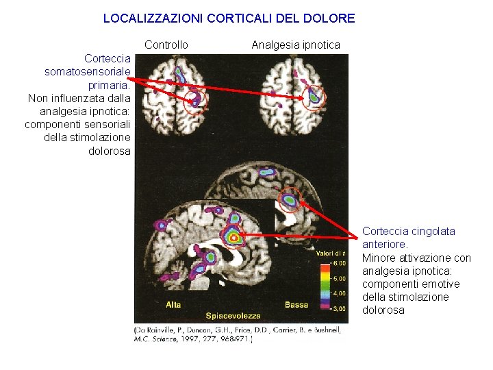 LOCALIZZAZIONI CORTICALI DEL DOLORE Controllo Analgesia ipnotica Corteccia somatosensoriale primaria. Non influenzata dalla analgesia