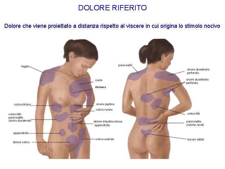 DOLORE RIFERITO Dolore che viene proiettato a distanza rispetto al viscere in cui origina