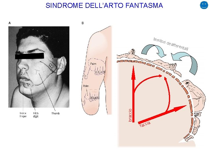 SINDROME DELL’ARTO FANTASMA territ braccio ori d ia facc eaffe renta ti 