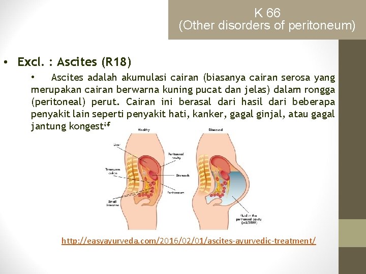 K 66 (Other disorders of peritoneum) • Excl. : Ascites (R 18) • Ascites