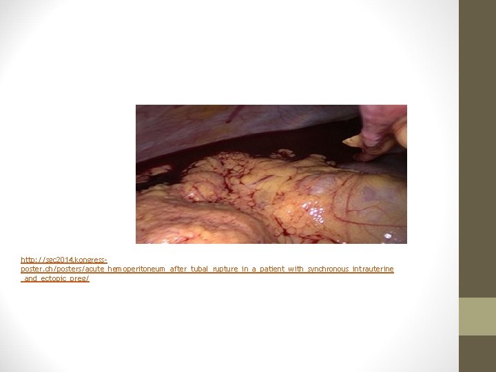 http: //sgc 2014. kongressposter. ch/posters/acute_hemoperitoneum_after_tubal_rupture_in_a_patient_with_synchronous_intrauterine _and_ectopic_preg/ 