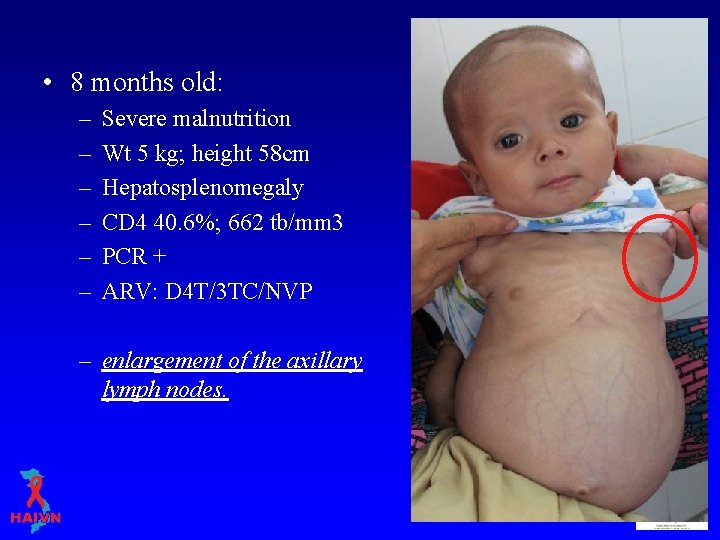  • 8 months old: – – – Severe malnutrition Wt 5 kg; height