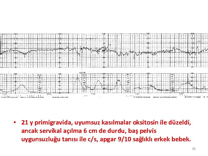  • 21 y primigravida, uyumsuz kasılmalar oksitosin ile düzeldi, ancak servikal açılma 6