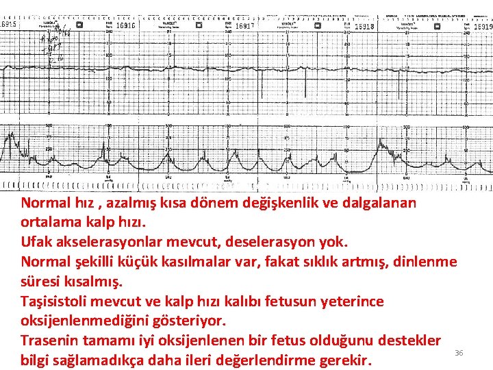 Normal hız , azalmış kısa dönem değişkenlik ve dalgalanan ortalama kalp hızı. Ufak akselerasyonlar