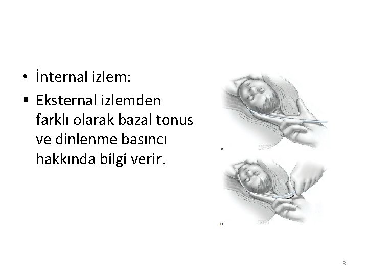  • İnternal izlem: § Eksternal izlemden farklı olarak bazal tonus ve dinlenme basıncı