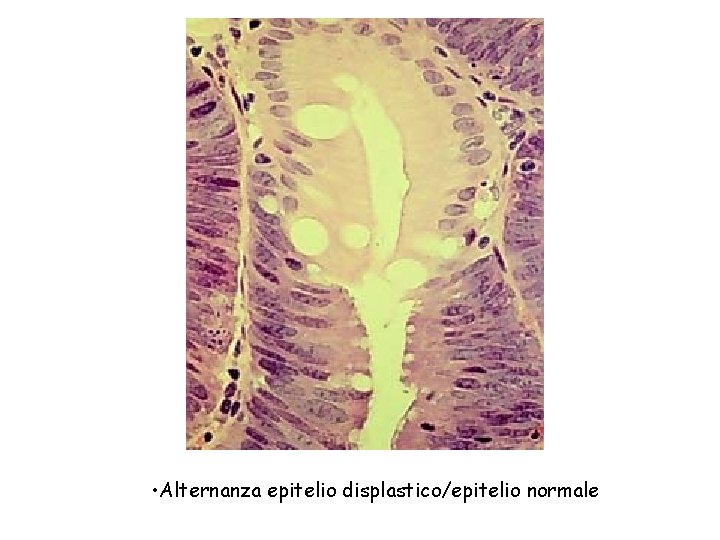  • Alternanza epitelio displastico/epitelio normale 