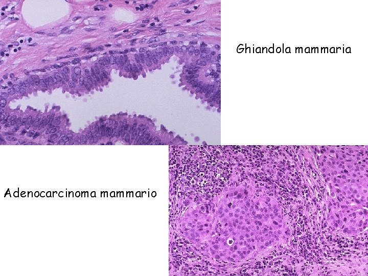 Ghiandola mammaria Adenocarcinoma mammario 