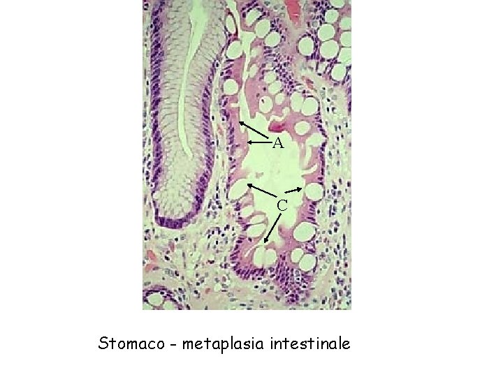 A C Stomaco - metaplasia intestinale 